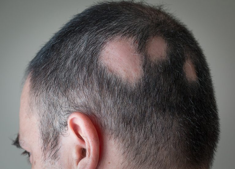 Alopecia Areata entenda um pouco sobre a doença Dermatolaser